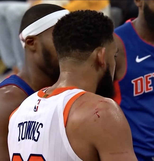 NBA赛场上演的\"血痕\"之争 唐斯肩部挂彩引热议